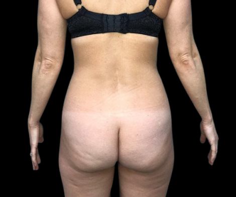 Female patient's buttock before fat transfer cosmetic surgery