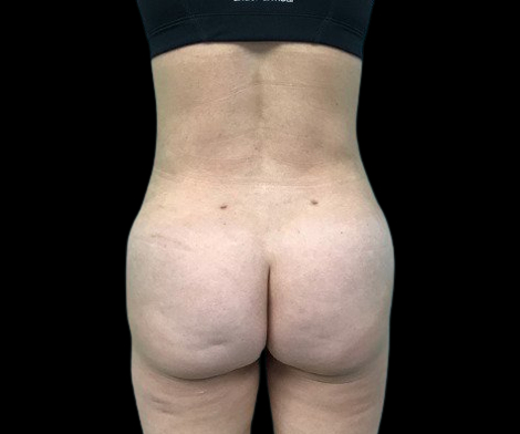 Female patient's buttock after fat transfer cosmetic surgery