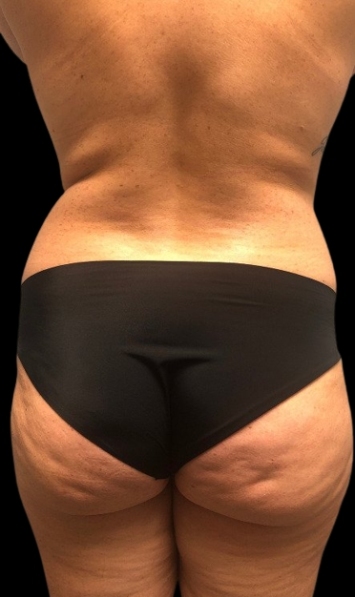 Female patient's back before body cosmetic surgery