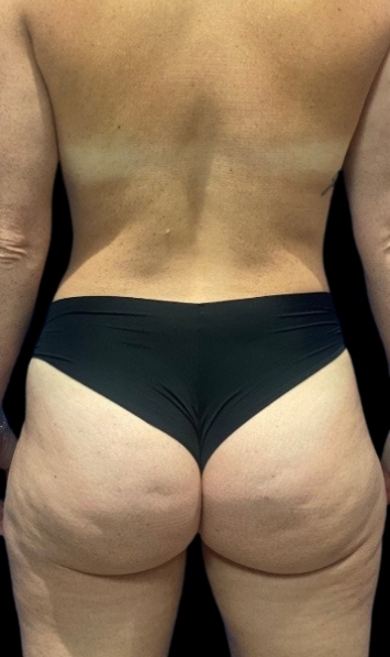 Female patient's back after body cosmetic surgery