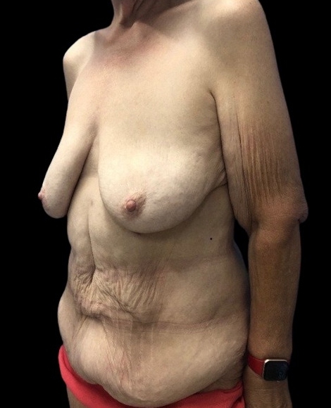 Female patient before body lift
