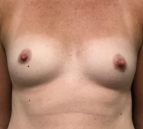 Female patient before breast augmentation