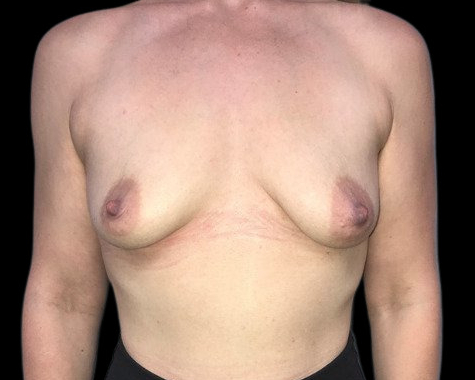 Female patient before breast augmentation with lift