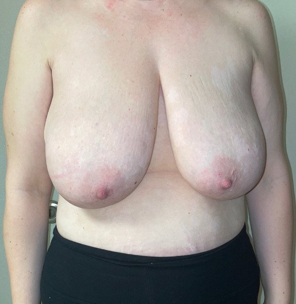 Female patient before breast lift