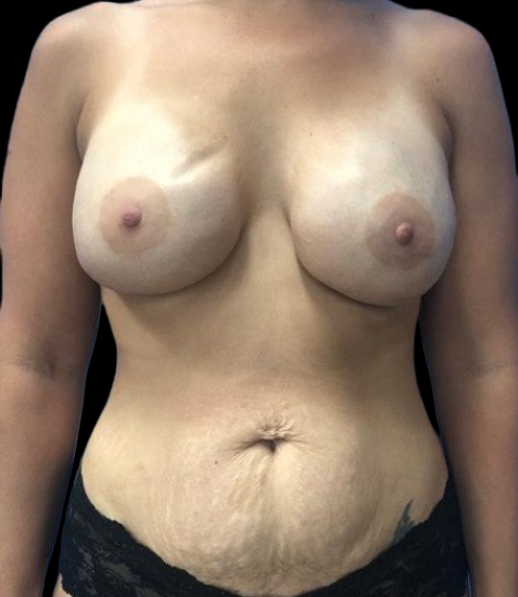 Female patient before breast reconstruction
