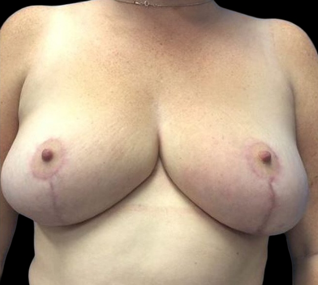 Female patient after breast reconstruction