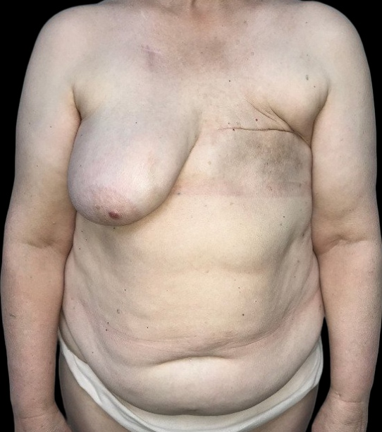 Female patient before breast reconstruction