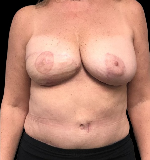 Female patient after breast reconstruction
