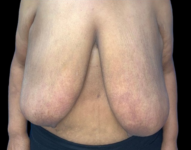 Female patient before breast reduction