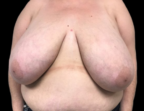 Female patient before breast reduction