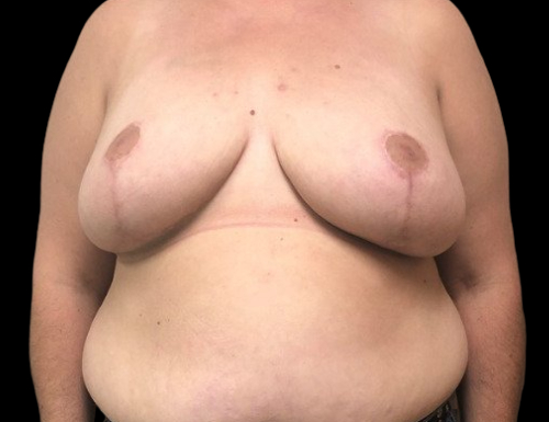 Female patient after breast reduction