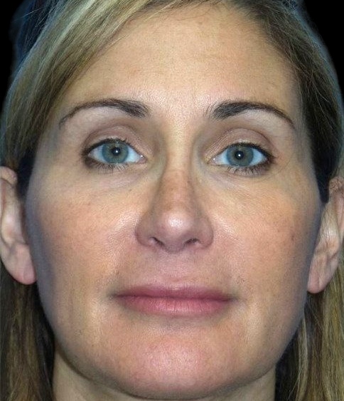 Female patient before buccal fat removal