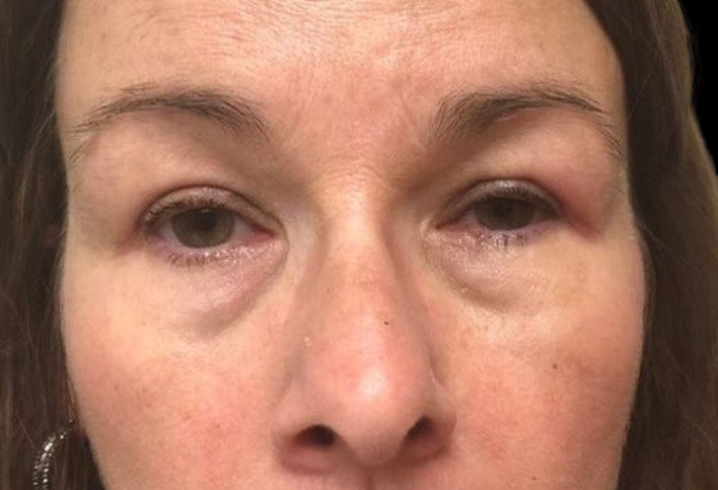 Female patient after eyelid surgery