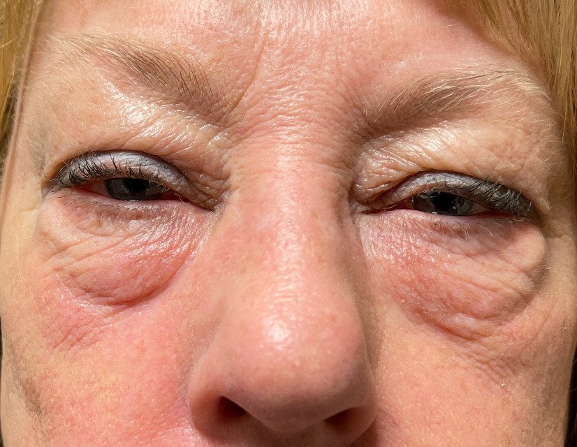Female patient before eyelid surgery