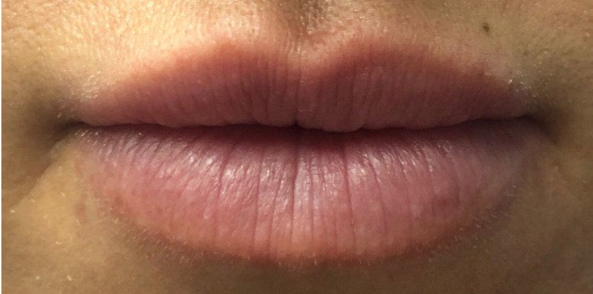 Female patient's lips before filler augmentation