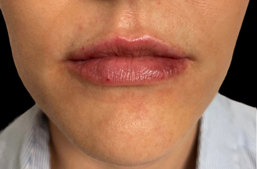 Female patient's lips after filler augmentation