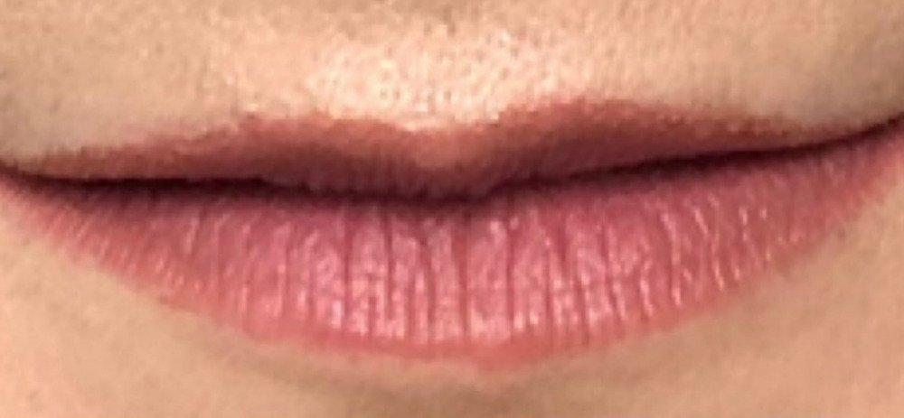 Female patient's lips before filler augmentation