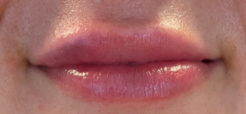 Female patient's lips after filler augmentation