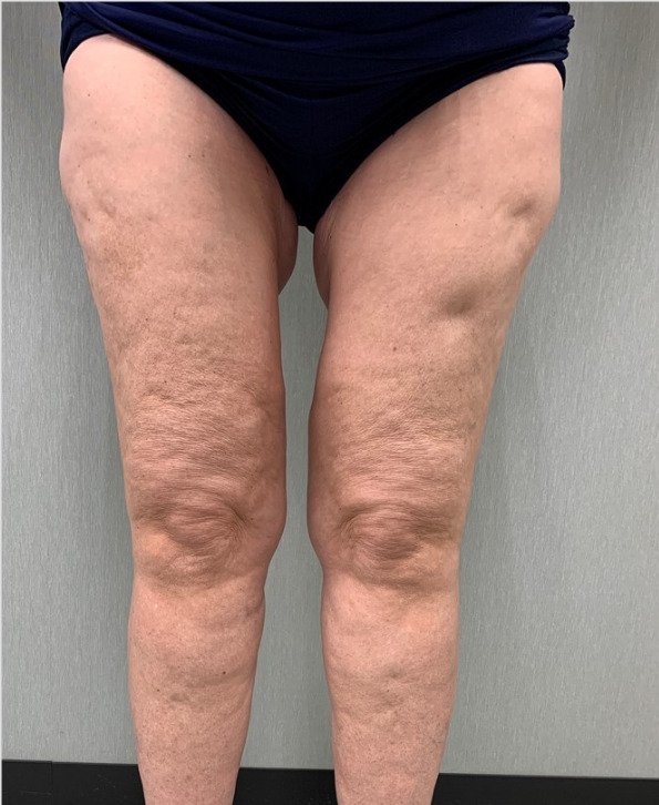 Female patient's legs after lipo
