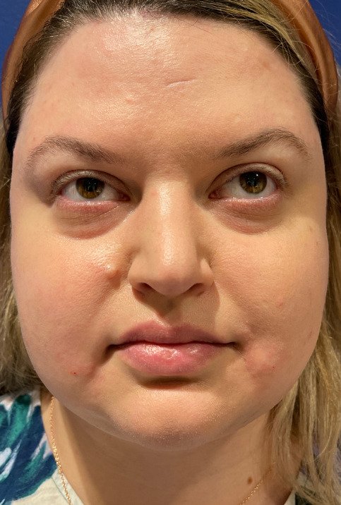 Female patient's face after liposuction