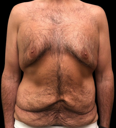 Male patient before body lift