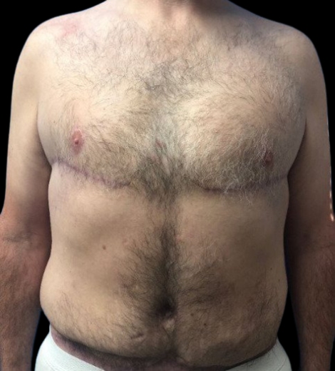 Male patient after body lift