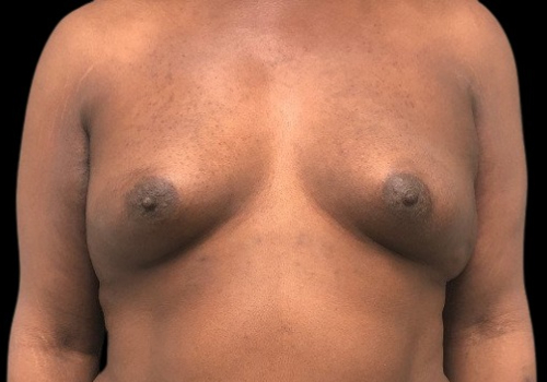 Patient before male to female breast augmentation