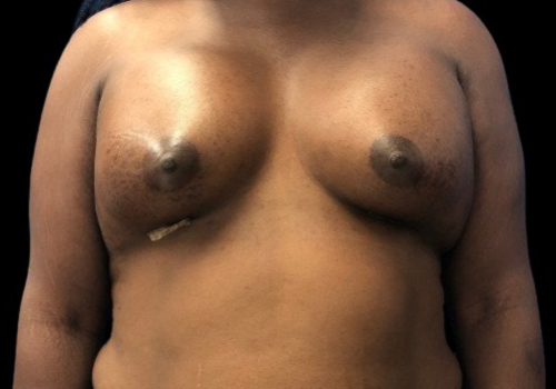 Patient after male to female breast augmentation
