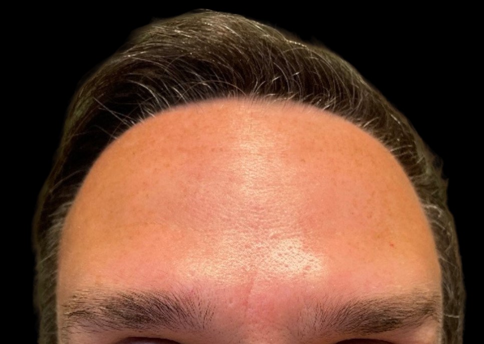Male patient's forehead after neuromodulator injections