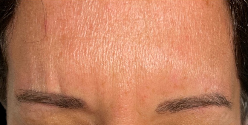Female patient's forehead after neuromodulator injections