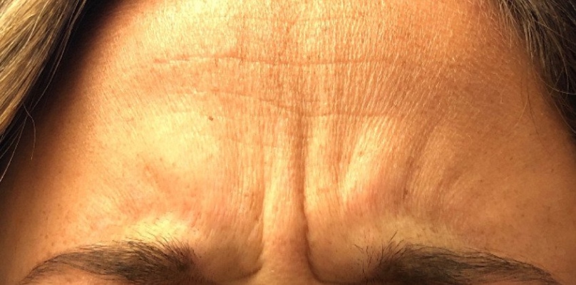 Female patient's forehead before neuromodulator injections