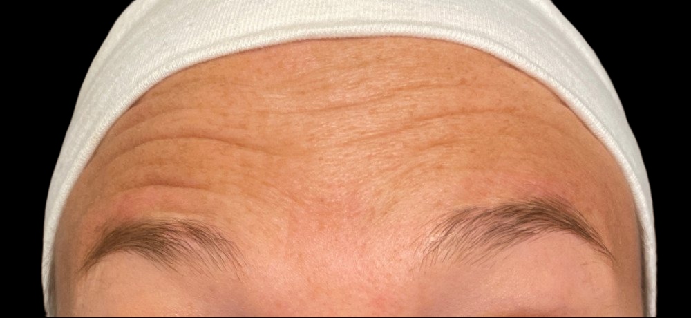 Female patient's forehead before neuromodulator injections