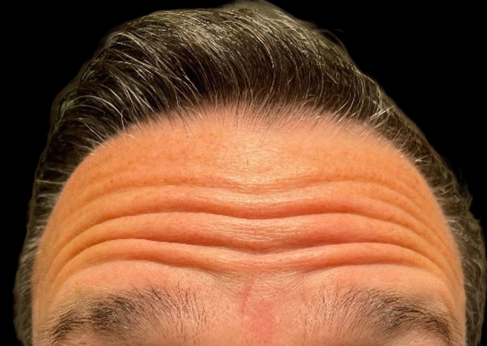 Male patient's forehead before neuromodulator injections