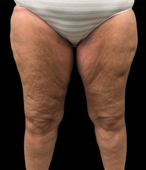 Female patient's legs before thighplasty