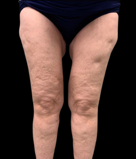 Female patient's legs after thighplasty