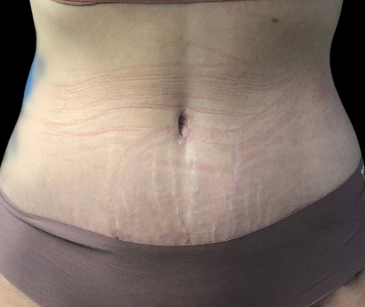 Female patient after tummy tuck