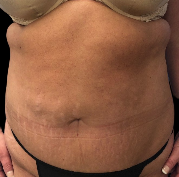 Female patient before tummy tuck