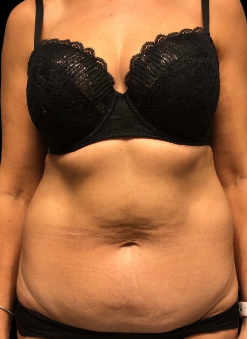 Female patient before tummy tuck