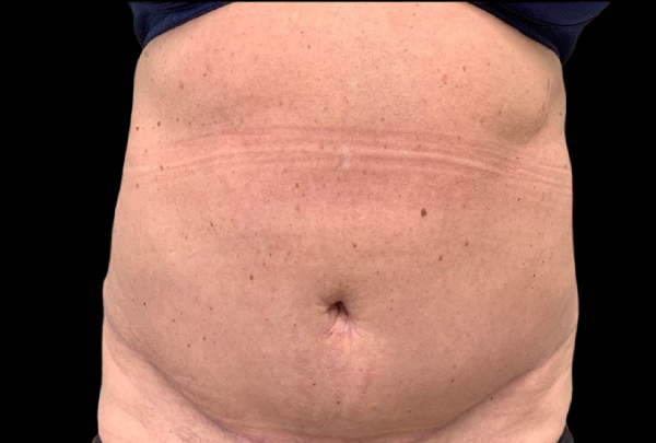 Female patient after tummy tuck