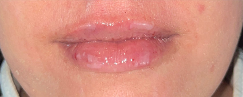 Patient's lips after lip filler augmentation