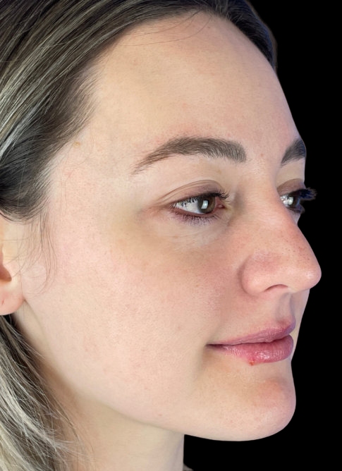 Woman's face after Lumecca treatment
