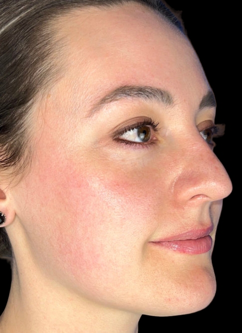 Woman's face before Lumecca treatment