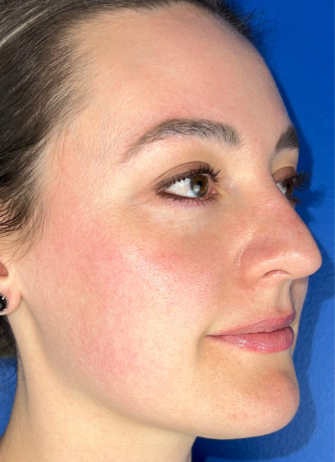 Woman's face before Lumecca treatment