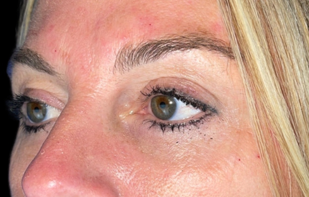 Woman's eyes area after Morpheus8 treatment