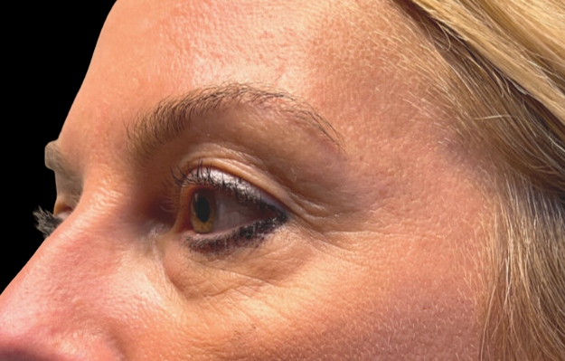 Woman's eyes area before Morpheus8 treatment
