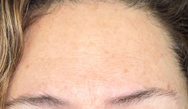 Woman's forehead after wrinkle relaxer procedure