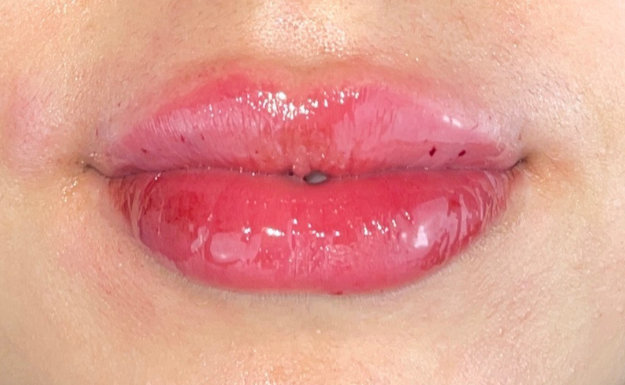 Patient's lips after filler lip augmentation