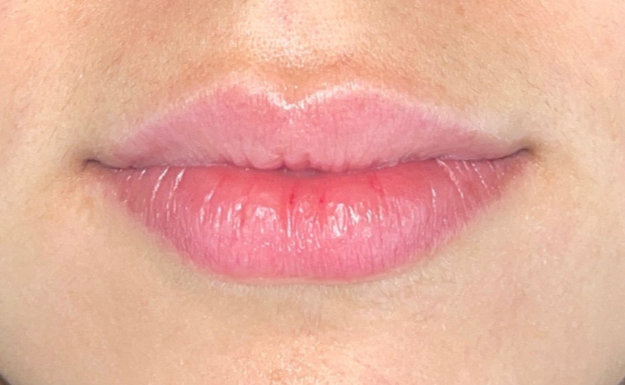 Patient's lips before lip augmentation