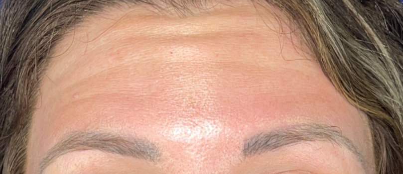 Woman's forehead before wrinkle relaxer procedure
