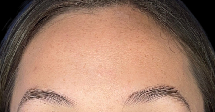 Woman's forehead after wrinkle relaxer procedure